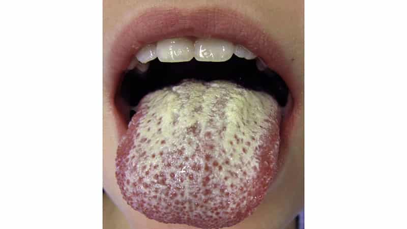 Как вылечить молочницу на языке у взрослого