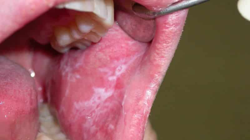 лейкоплакия языка фото