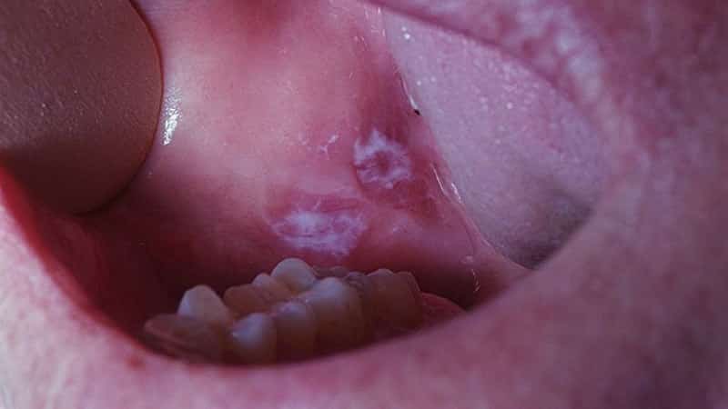 лейкоплакия полости рта симптомы лечение