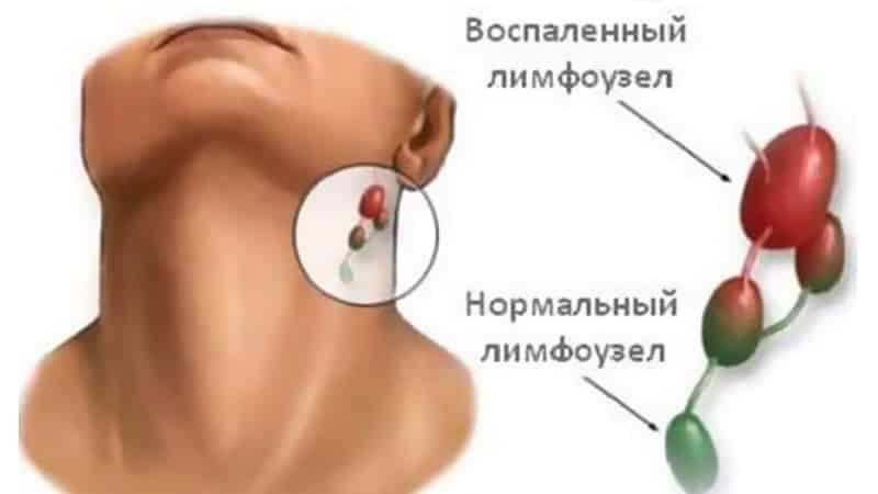 лимфаденит подчелюстной причины