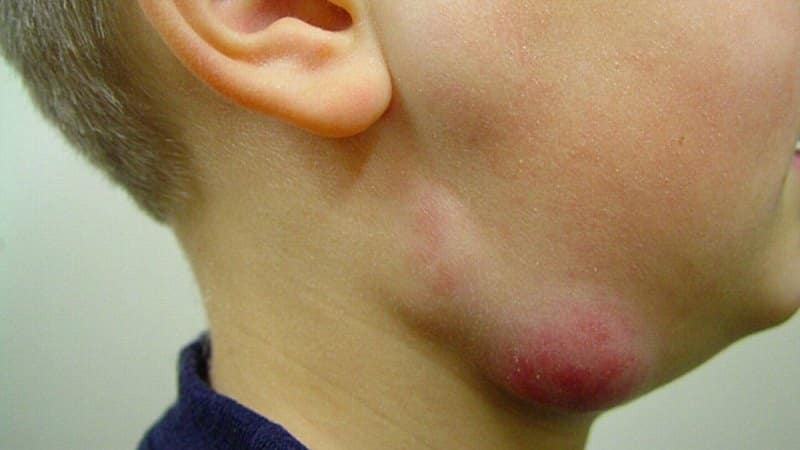 подчелюстной лимфаденит симптомы лечение