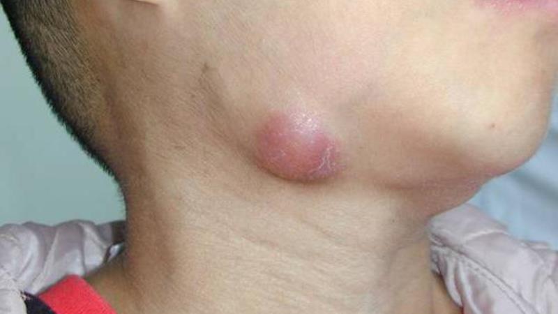 как лечить подчелюстной лимфаденит