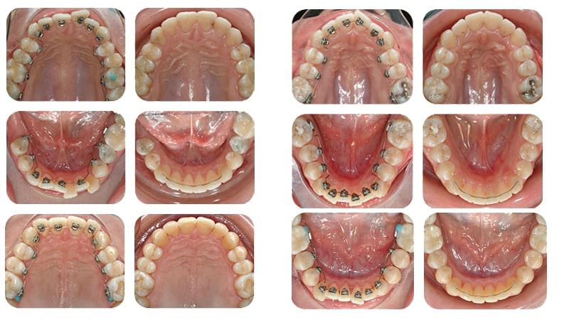 внутренние брекеты отзывы