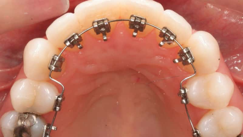 лингвальные брекеты фото до и после