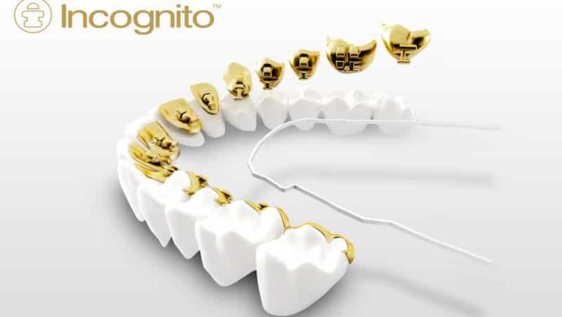 лингвальные брекеты что это такое