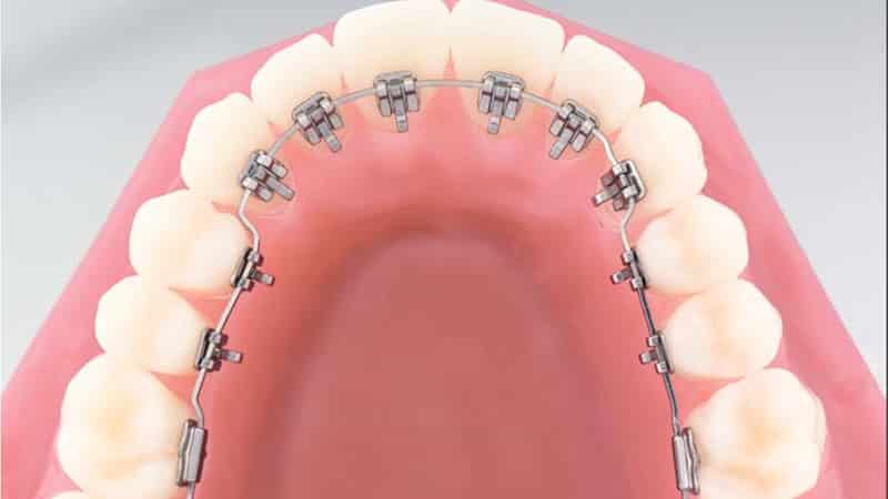 внутренние брекеты фото