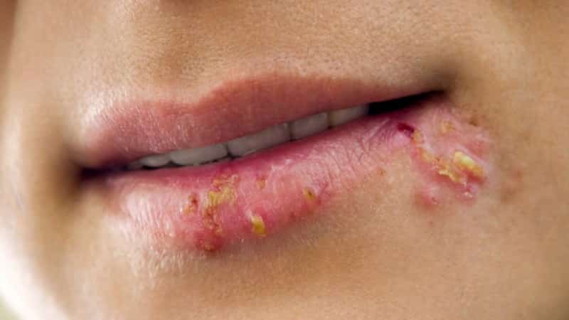 самое лучшее средство от герпеса на губах
