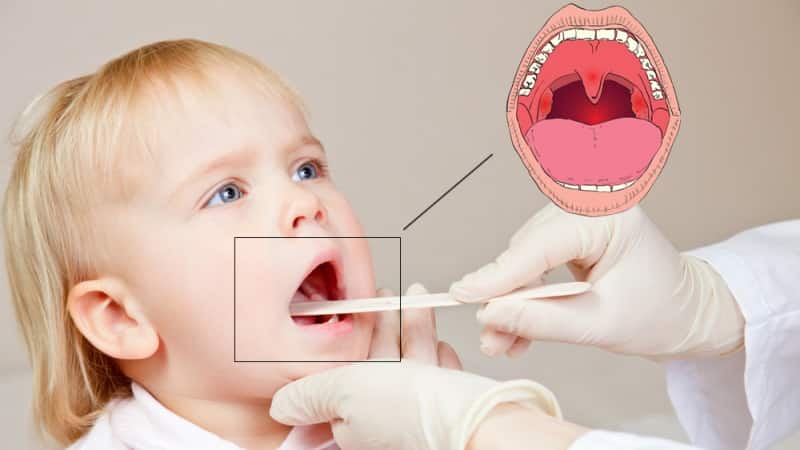 лучшее лекарство от тонзиллита