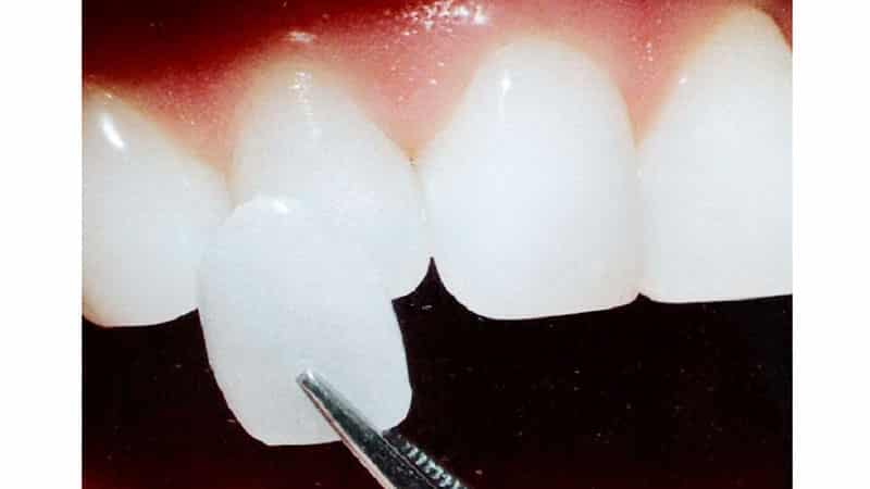 Примерка и крепление люминиров на зубы