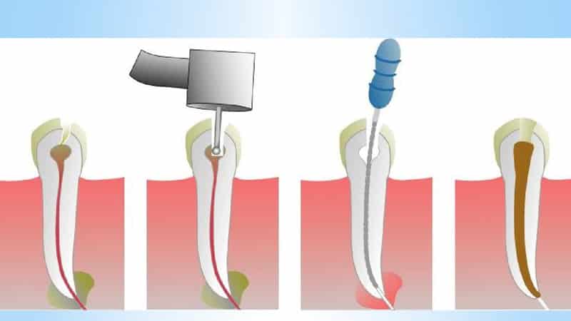 Материалы для пломбирования корневых каналов зубов