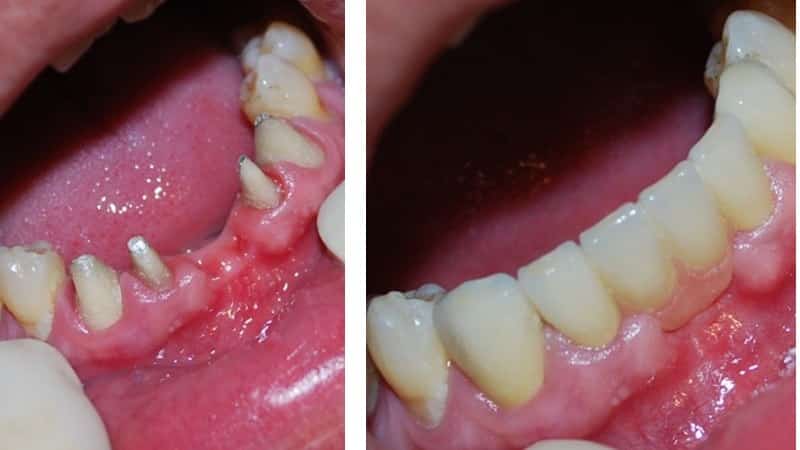 металлокерамика на передние зубы