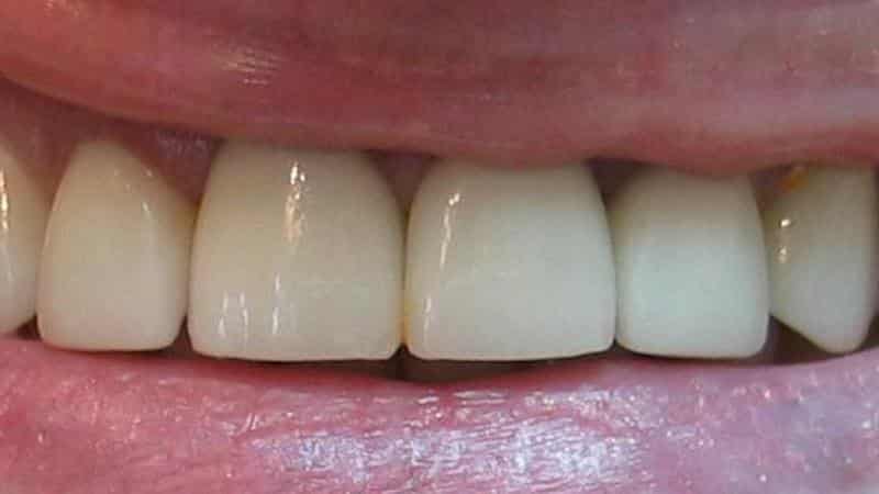 Преимущества металлокерамических протезов