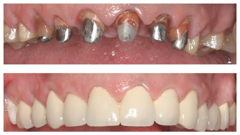 металлокерамические коронки плюсы и минусы