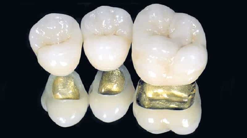 металлокерамика зубы фото до и после