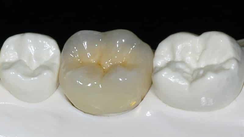 коронки металлокерамика фото до и после