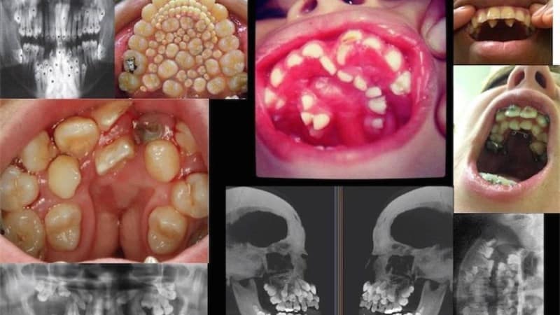 сверхкомплектные зубы фото
