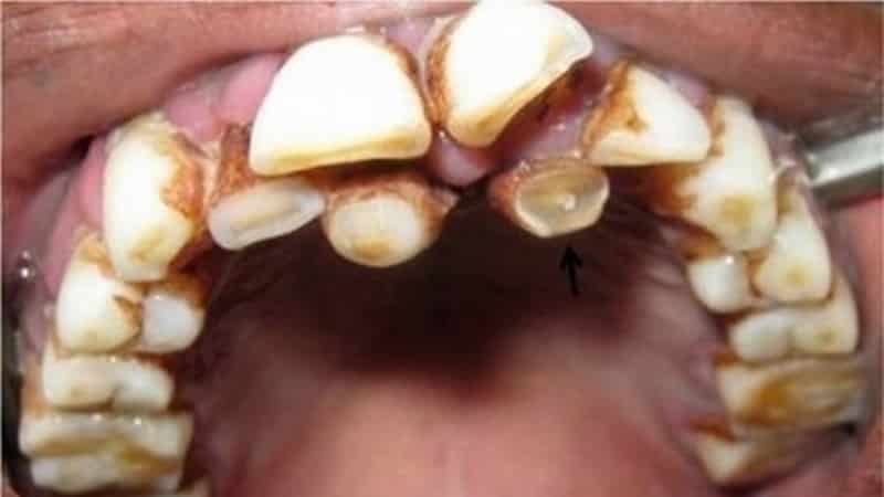 сверхкомплектный зуб у ребенка фото