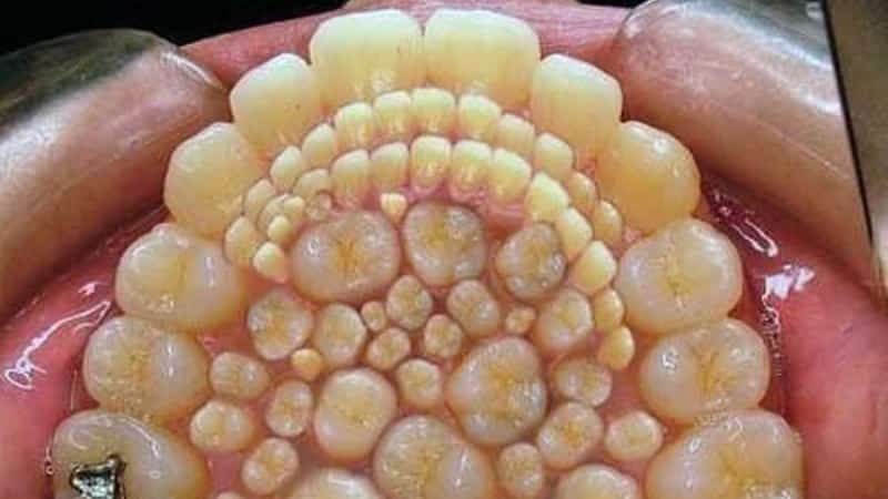 удаление сверхкомплектного зуба у ребенка