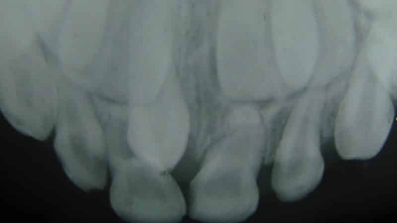 гипердонтия фото