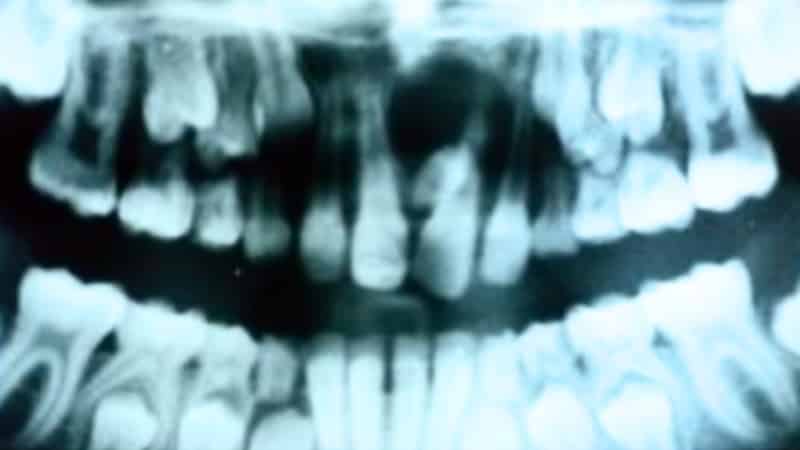 много зубов во рту болезнь фото