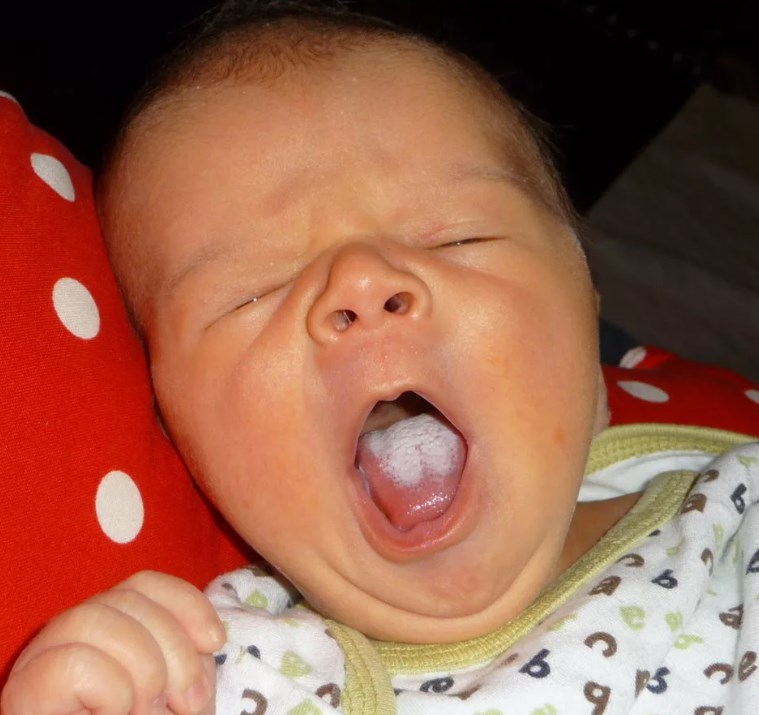 Как лечить молочницу во рту у взрослых