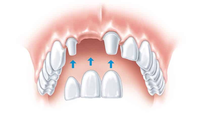 зубной мост на 3 зуба фото