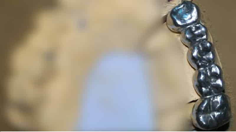 мост на зубы фото