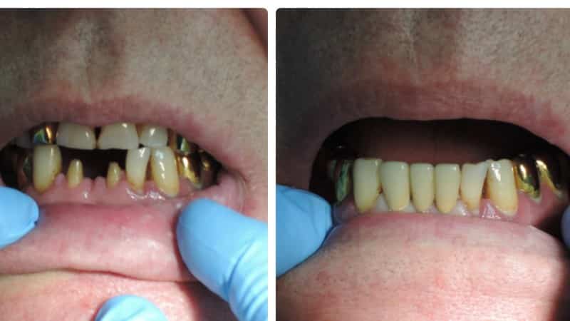 как ставят мост на зубы