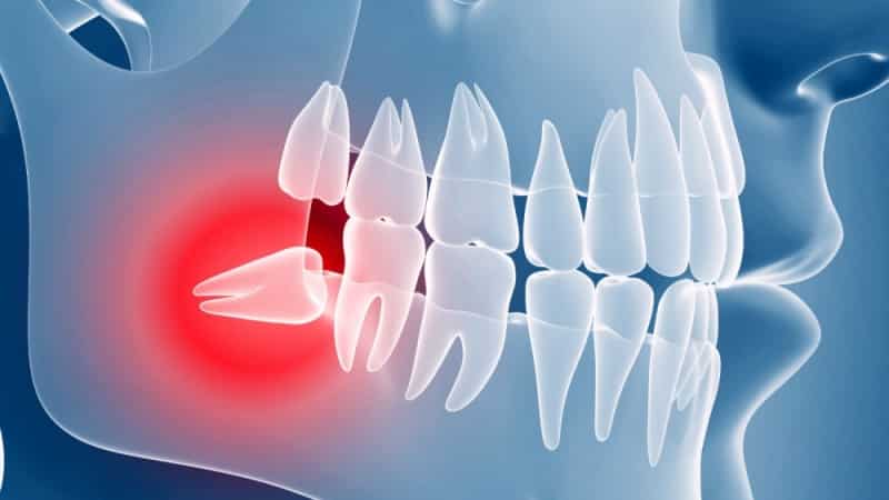 зубная боль отдает в висок