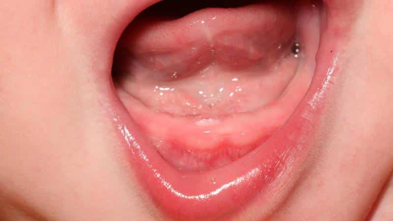 может ли быть сыпь при прорезывании зубов у ребенка