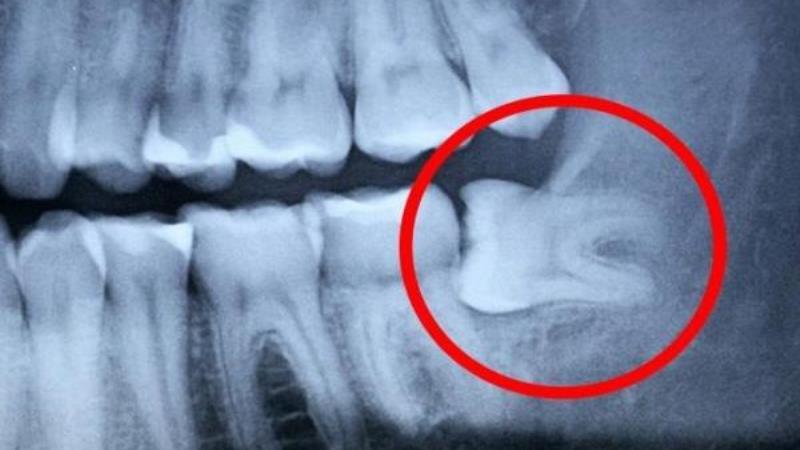 после удаления зуба болит голова