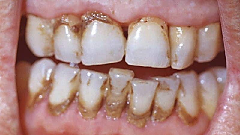 можно ли курить после лечения удаления зуба мудрости когда