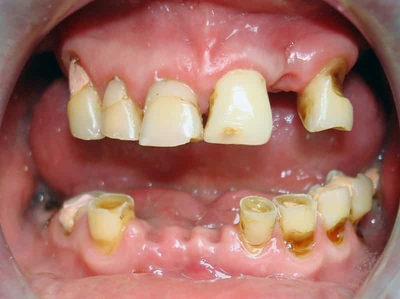 почему нельзя курить после удаления зуба можно