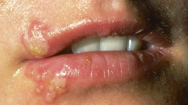 можно ли лечить зубы при насморке