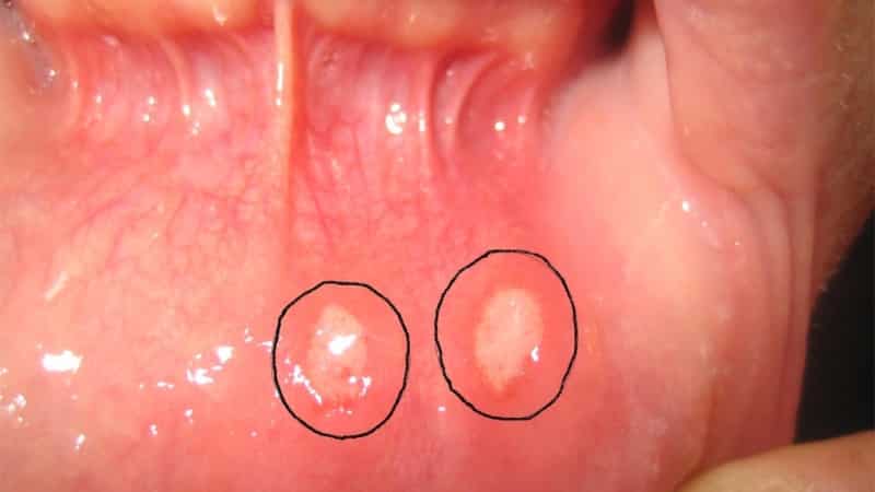 можно ли мазать стоматит зеленкой