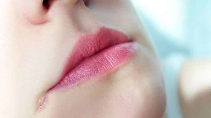 зеленка и стоматит