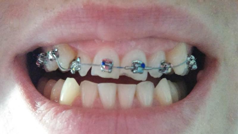 можно ли ставить брекеты на одну челюсть