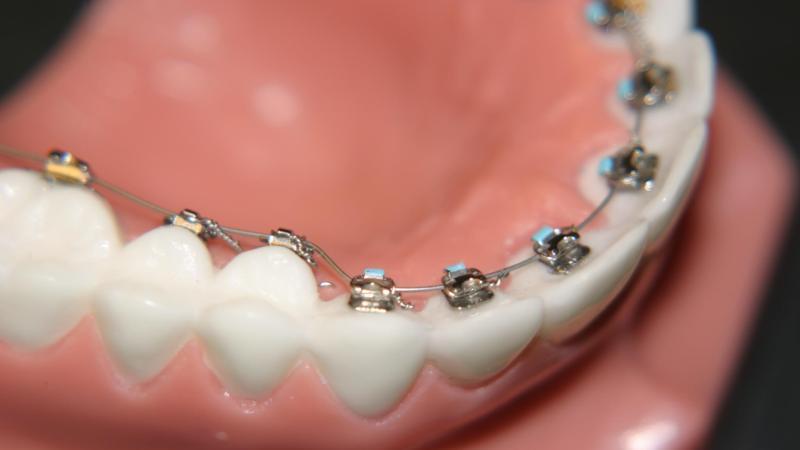 ставят ли брекеты на одну челюсть