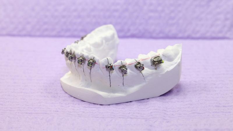 брекеты на нижнюю челюсть