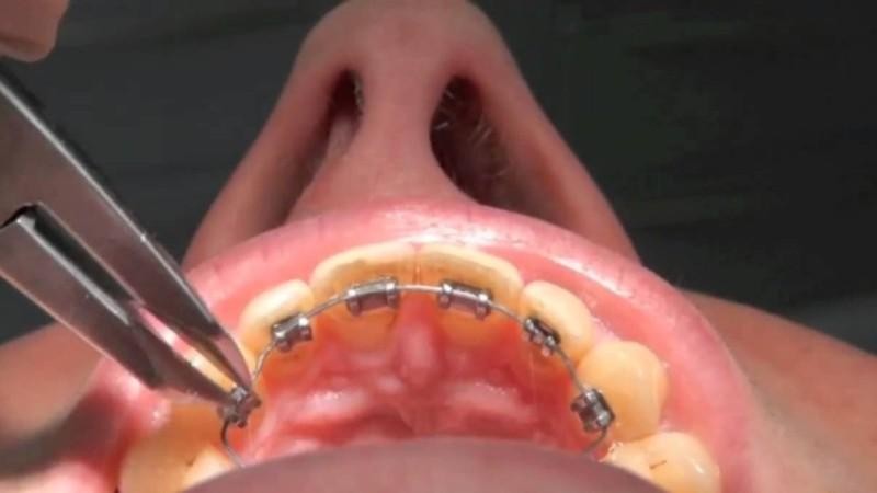 брекеты только на нижнюю челюсть