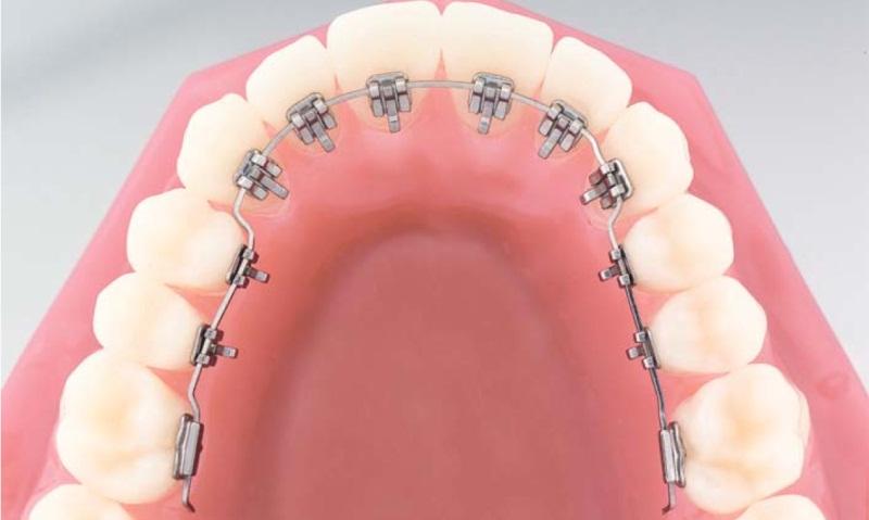 брекеты на нижнюю челюсть фото