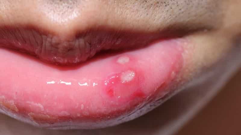 на губах белые точки