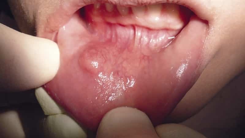 на губе появилась шишка с внутренней стороны