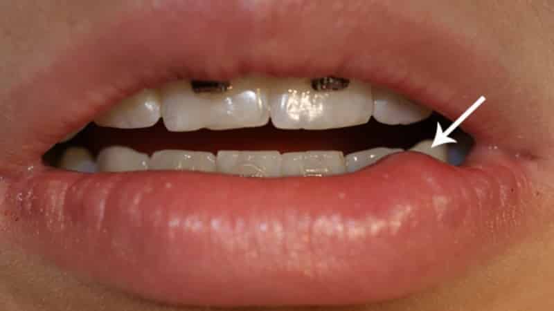 шишка на внутренней стороне губы