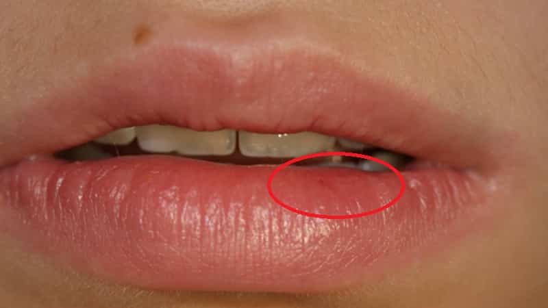 прикусила губу образовался шарик внутри губы