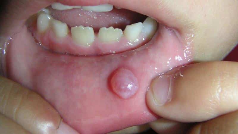 шишка на губе внутри фото