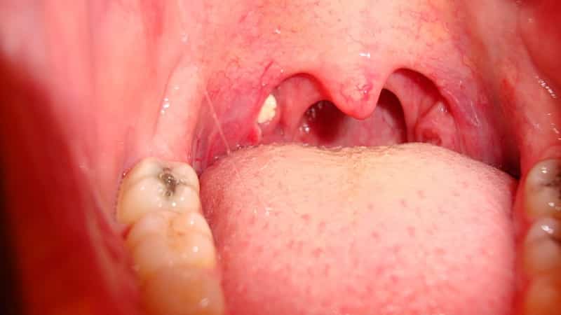 на миндалинах белые точки