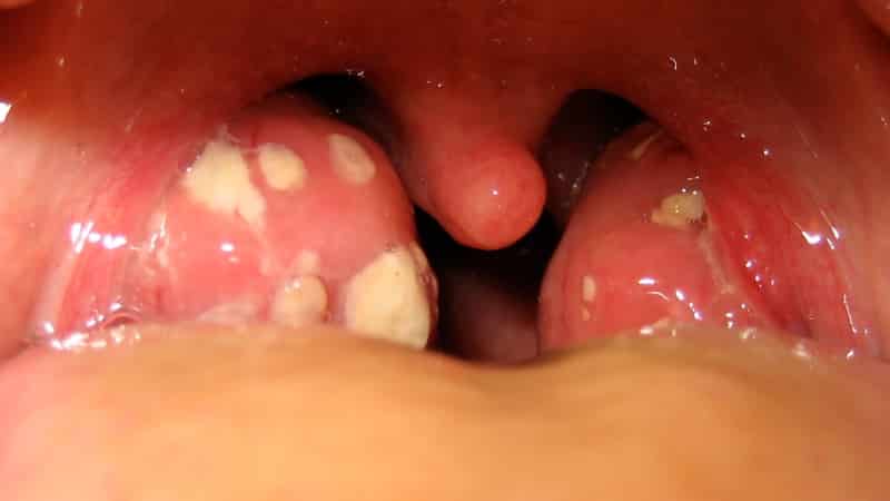 белые пятна на гландах