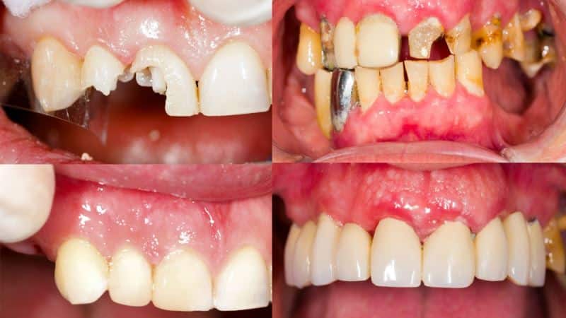 наращивание передних зубов фото до и после