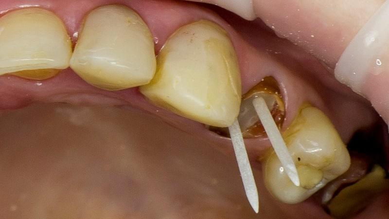 наращивание переднего зуба